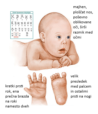 Nuhalna svetlina - Downov sindrom